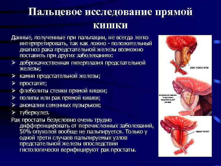 Пальцевое исследование прямой кишки Данные, полученные при пальпации, не всегда легко интерпретировать, так как