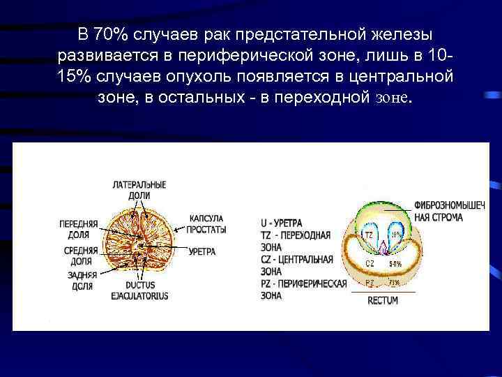 В 70% случаев рак предстательной железы развивается в периферической зоне, лишь в 1015% случаев