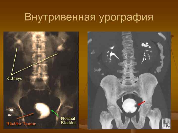 Внутривенная урография 