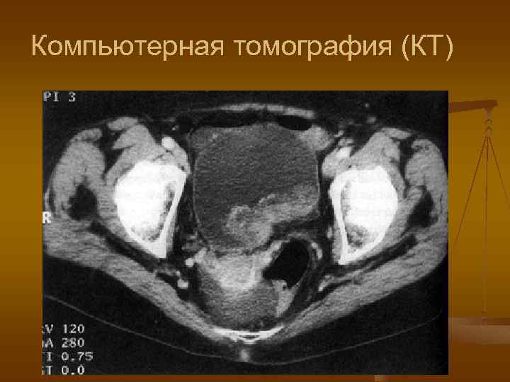 Мрт мочевого. Опухоль мочевого пузыря на кт.