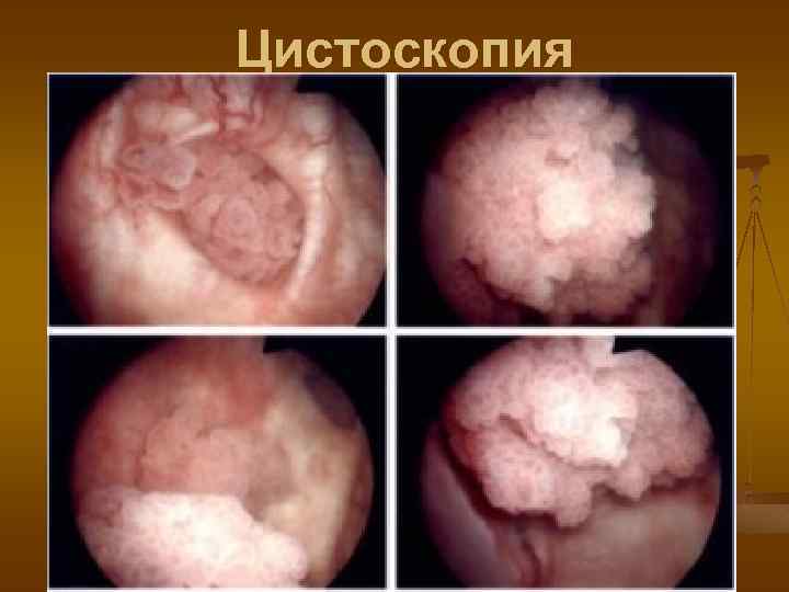 Цистоскопия 