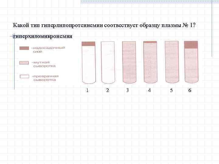 Какой тип гиперлипопротеинемии соотвествует образцу плазмы № 1? гиперхиломикронемия 1 2 3 4 5