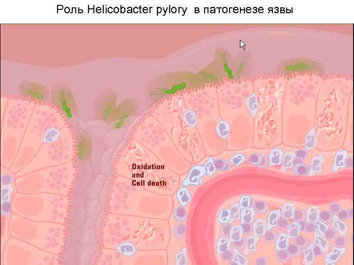 Роль Helicobacter pylory в патогенезе язвы 