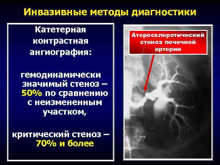 Инвазивные методы диагностики Катетерная контрастная ангиография: гемодинамически значимый стеноз – 50% по сравнению с