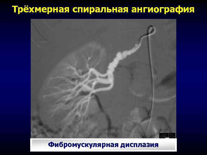 Трёхмерная спиральная ангиография Фибромускулярная дисплазия 