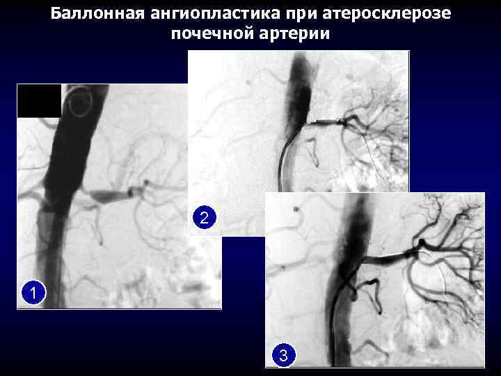 Тромбоз почечной артерии. Фибромышечная дисплазия почечных артерий. Ангиопластика почечных артерий. Баллонная ангиопластика почечной артерии. Баллонная дилатация почечной артерии.