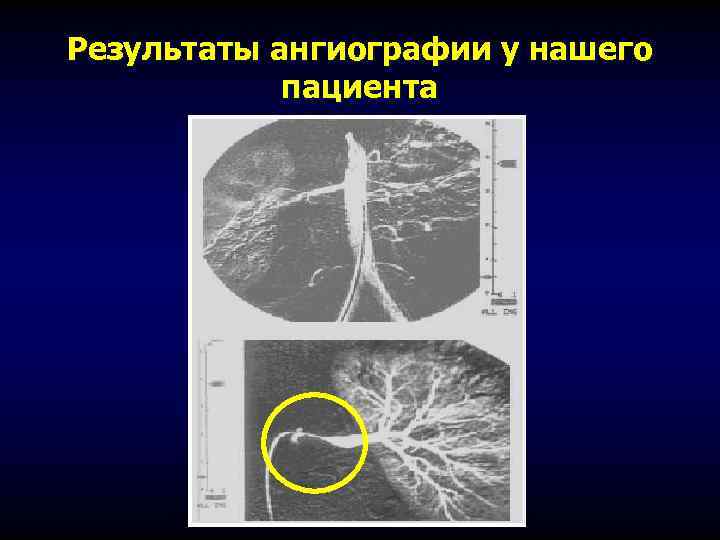 Результаты ангиографии у нашего пациента 