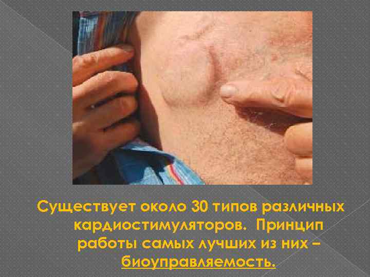 Существует около 30 типов различных кардиостимуляторов. Принцип работы самых лучших из них – биоуправляемость.