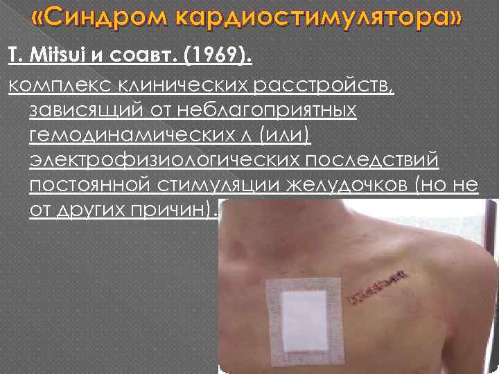  «Синдром кардиостимулятора» Т. Mitsui и соавт. (1969). комплекс клинических расстройств, зависящий от неблагоприятных