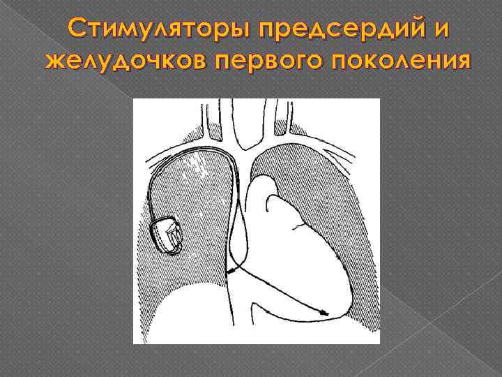 Стимуляторы предсердий и желудочков первого поколения 