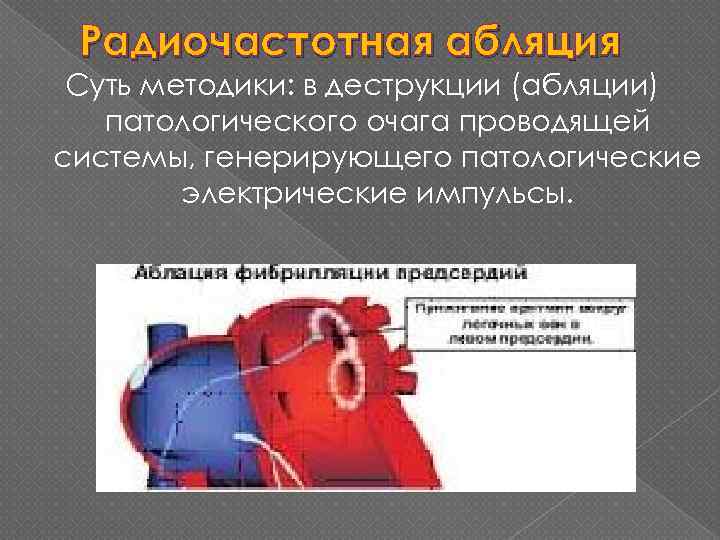 Радиочастотная абляция Суть методики: в деструкции (абляции) патологического очага проводящей системы, генерирующего патологические электрические
