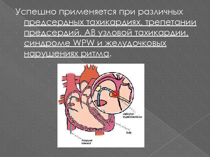 Успешно применяется при различных предсердных тахикардиях, трепетании предсердий, АВ узловой тахикардии, синдроме WPW и