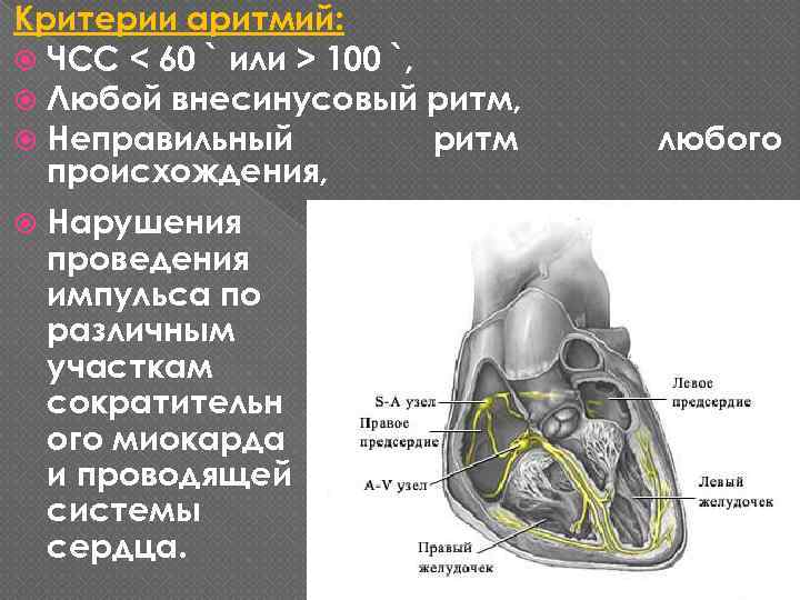 Критерии аритмий: ЧСС < 60 ` или > 100 `, Любой внесинусовый ритм, Неправильный