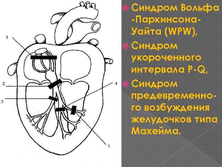  Синдром Вольфа -Паркинсона. Уайта (WPW), Синдром укороченного интервала P-Q, Синдром предевременного возбуждения желудочков