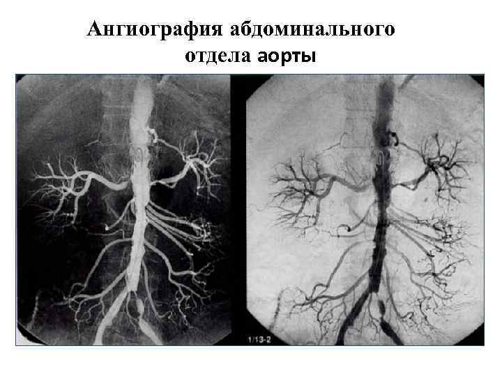 Почечная ангиография презентация