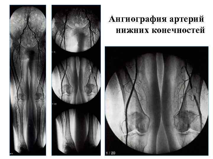 Вены нижних конечностей кт. Рентгеноконтрастная ангиография нижних конечностей. Атеросклероз артерий нижних конечностей ангиография. Мрт ангиография нижних конечностей. Кт ангиография нижних конечностей.