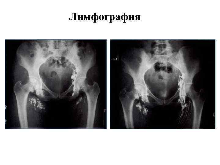 Лимфография 