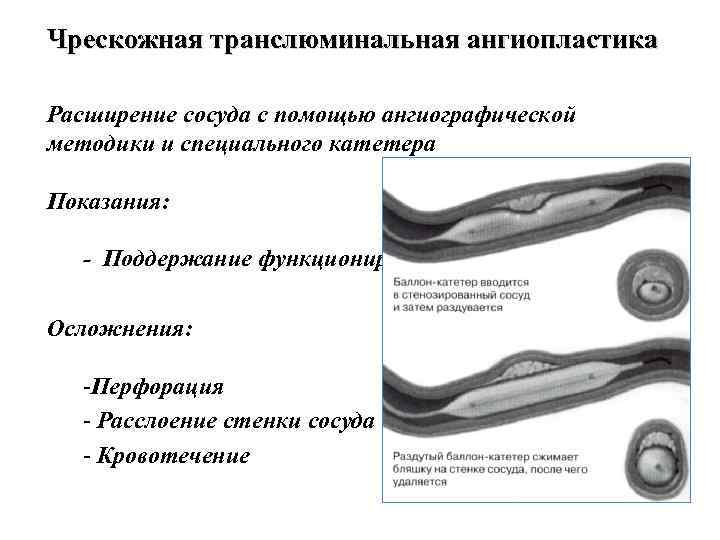 Чрескожная ангиопластика. ТРАНСЛЮМИНАЛЬНАЯ коронарная ангиопластика. Баллонная ангиопластика показания. Чрескожная баллонная коронарная ангиопластика. ТРАНСЛЮМИНАЛЬНАЯ баллонная ангиопластика легочных артерий.