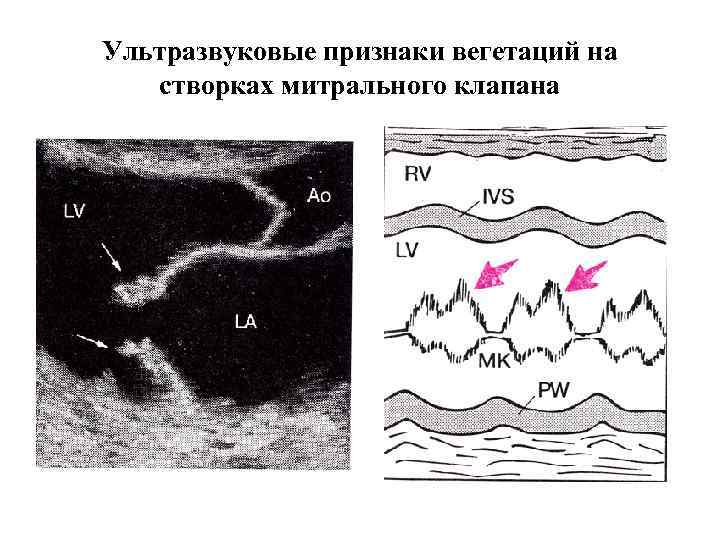 Ультразвуковые признаки вегетаций на створках митрального клапана 