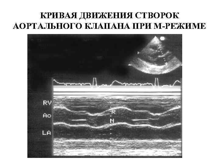 М режим. М режим аортальный клапан. УЗИ аортальный клапан движение створок. Переднесистолическое движение передней створки митрального. Переднесистолическое движение створки митрального клапана.