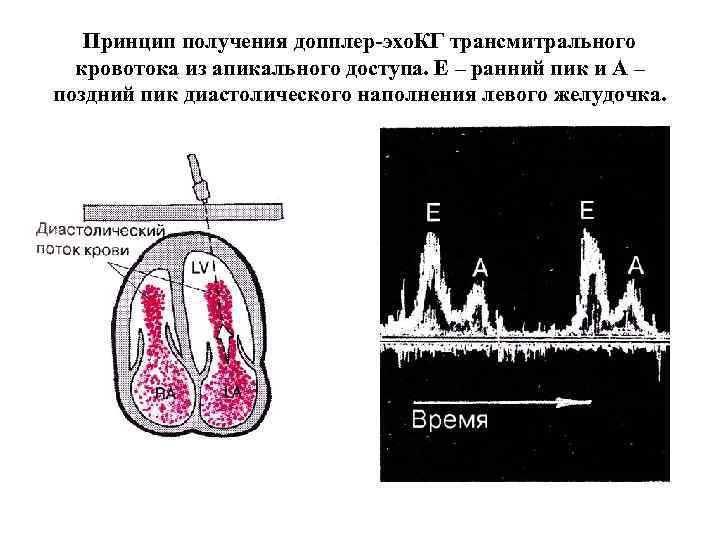 Принцип получения допплер-эхо. КГ трансмитрального кровотока из апикального доступа. Е – ранний пик и