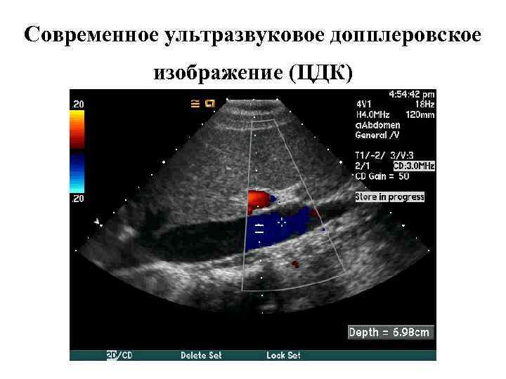 Современное ультразвуковое допплеровское изображение (ЦДК) 