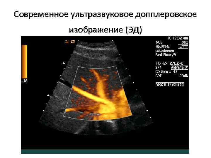 Современное ультразвуковое допплеровское изображение (ЭД) 