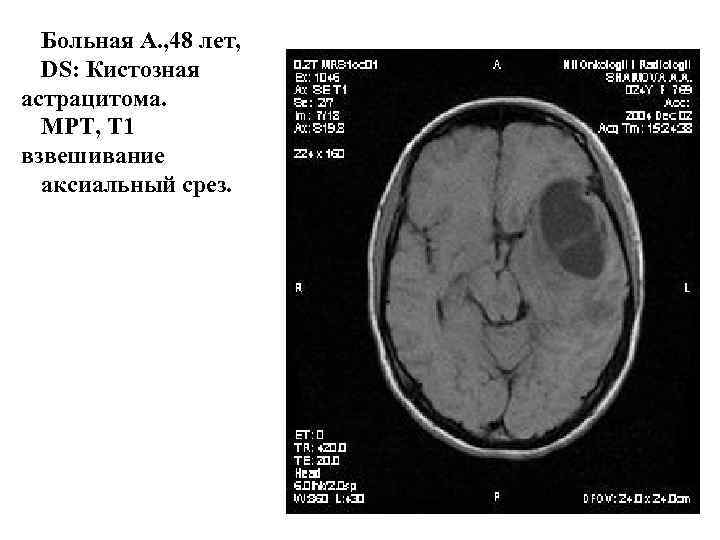 Больная А. , 48 лет, DS: Кистозная астрацитома. МРТ, Т 1 взвешивание аксиальный срез.