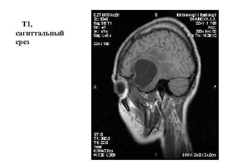 Т 1, сагиттальный срез 