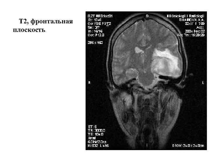 Т 2, фронтальная плоскость 