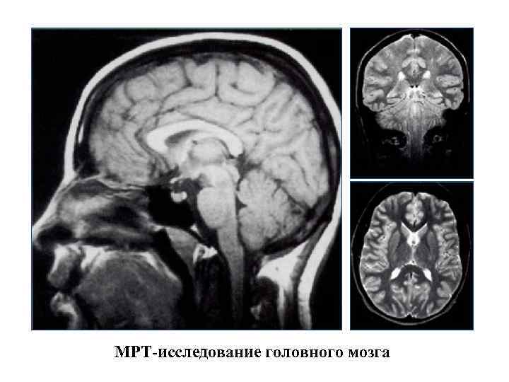 МРТ-исследование головного мозга 