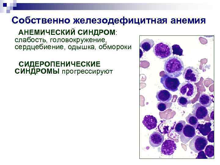 Собственно железодефицитная анемия АНЕМИЧЕСКИЙ СИНДРОМ: слабость, головокружение, сердцебиение, одышка, обмороки СИДЕРОПЕНИЧЕСКИЕ СИНДРОМЫ прогрессируют 