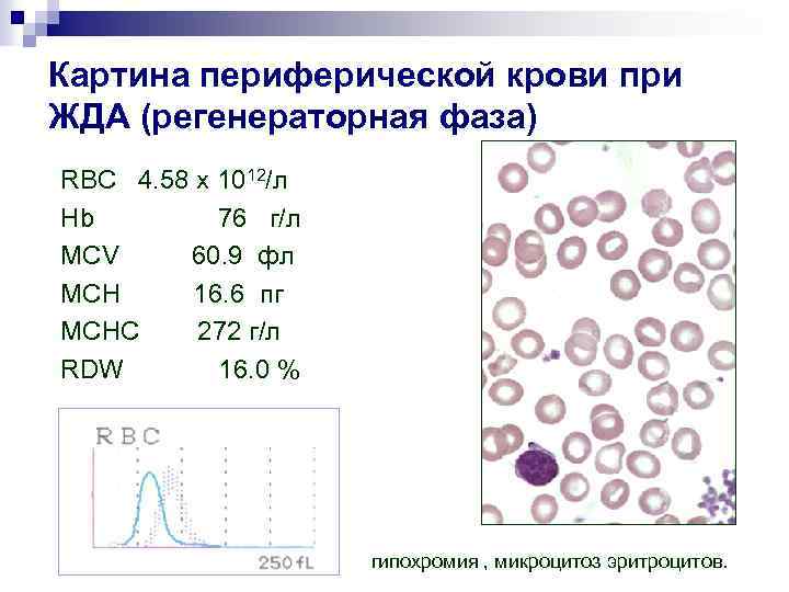 Картина периферической крови при ЖДА (регенераторная фаза) RBC 4. 58 x 1012/л Hb 76