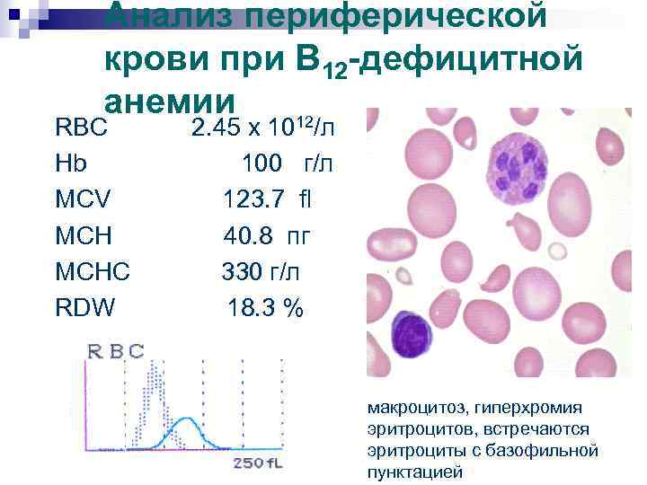 Анализ периферической крови при В 12 -дефицитной анемии 12 RBC 2. 45 x 10