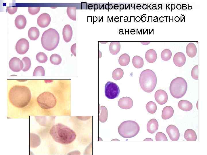 Картина крови при мегалобластной анемии