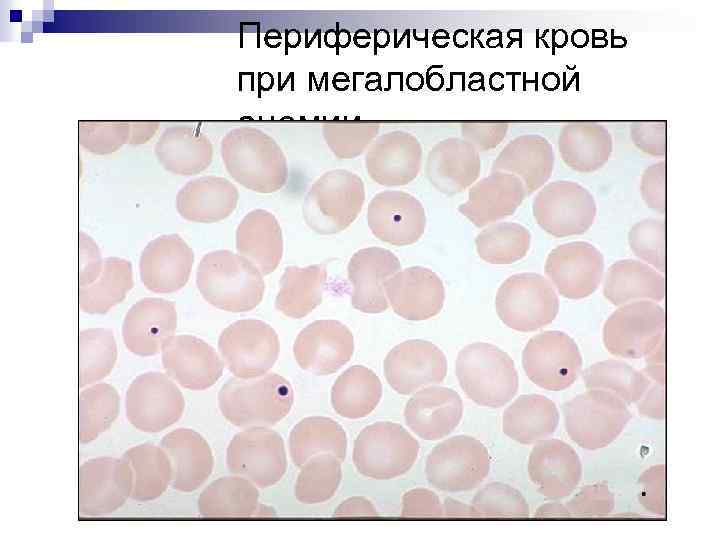 Периферическая кровь при мегалобластной анемии 