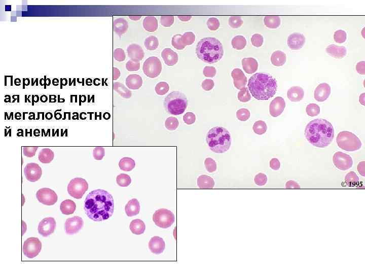 Периферическ ая кровь при мегалобластно й анемии 