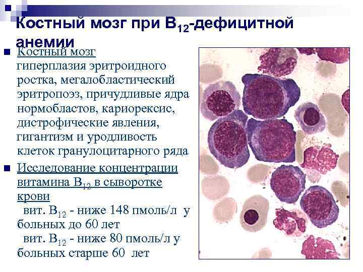 Картина крови при в12 дефицитной анемии