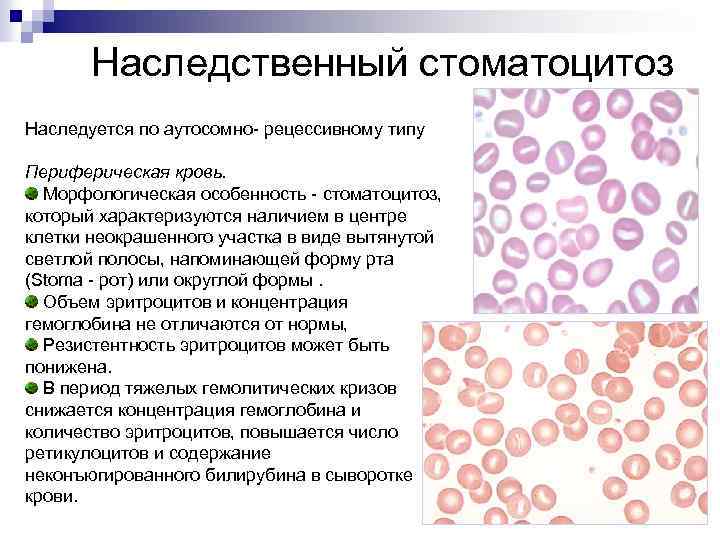 Наследственный стоматоцитоз Наследуется по аутосомно- рецессивному типу Периферическая кровь. Морфологическая особенность - стоматоцитоз, который