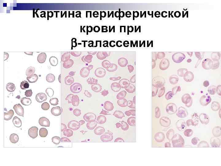 Картина крови при талассемии