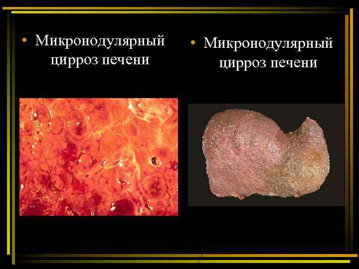  • Микронодулярный цирроз печени 