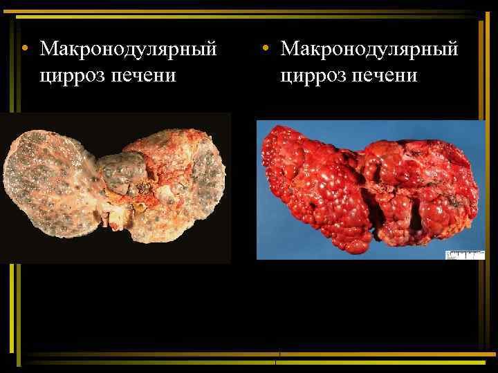  • Макронодулярный цирроз печени 