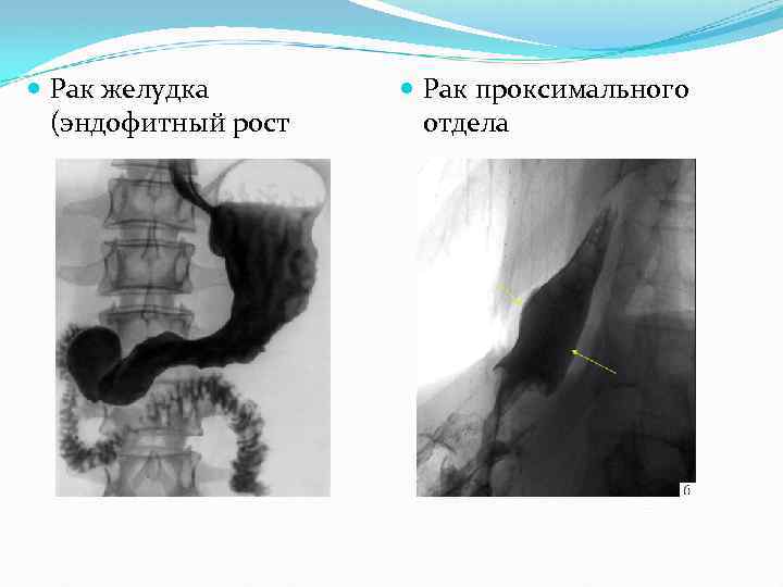 Рентгенологическая картина рака пищевода экзофитный эндофитный