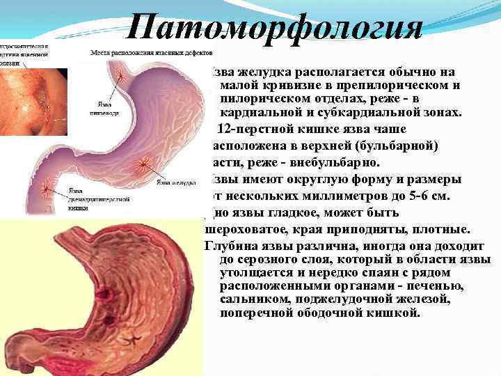 Патоморфология Язва желудка располагается обычно на малой кривизне в препилорическом и пилорическом отделах, реже