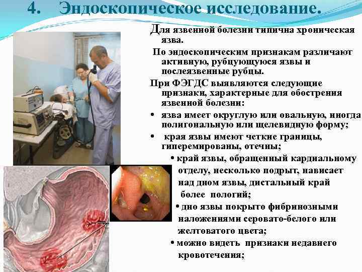 4. Эндоскопическое исследование. Для язвенной болезни типична хроническая язва. По эндоскопическим признакам различают активную,