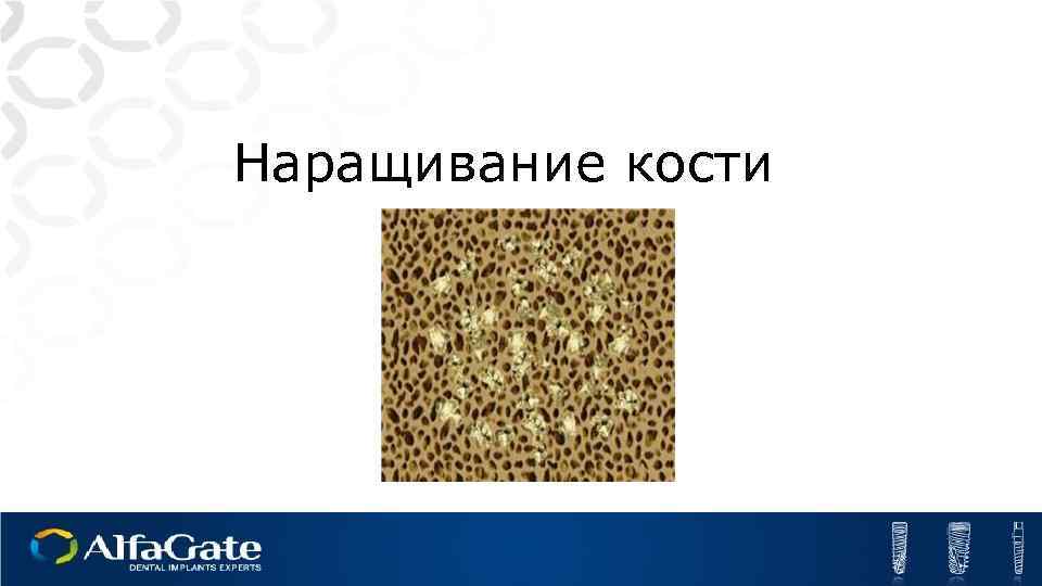 Наращивание кости 