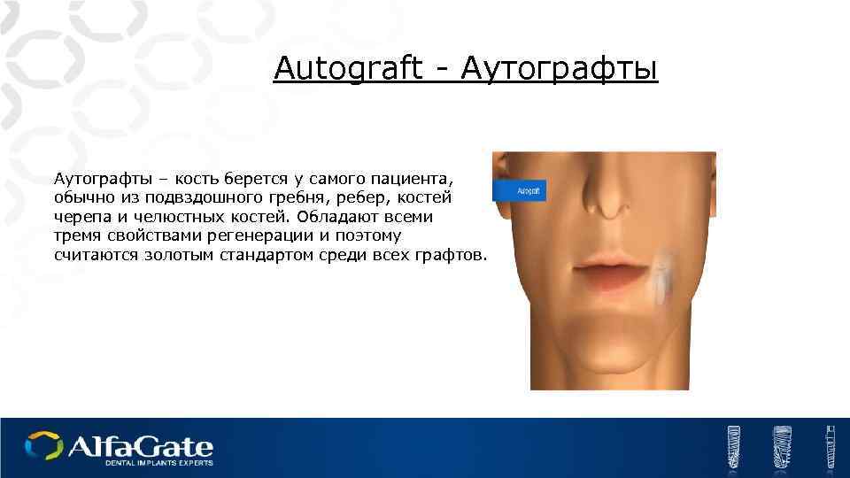 Autograft - Аутографты – кость берется у самого пациента, обычно из подвздошного гребня, ребер,