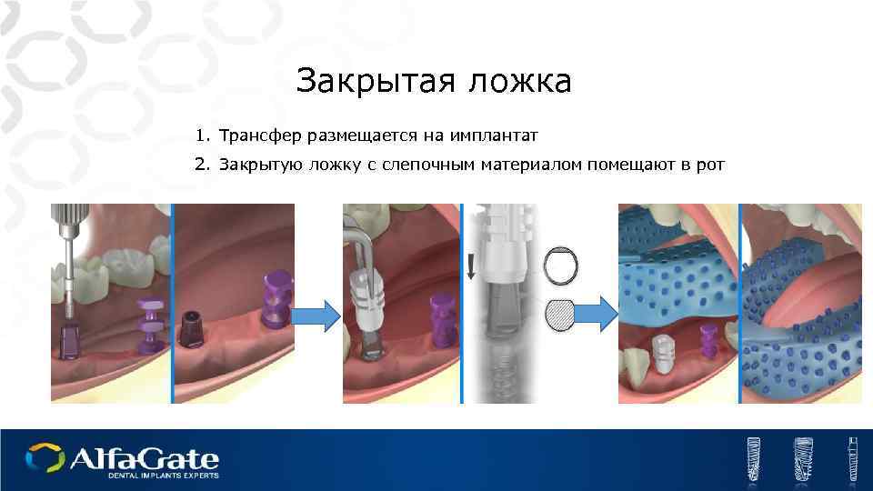 Закрытая ложка 1. Трансфер размещается на имплантат 2. Закрытую ложку с слепочным материалом помещают