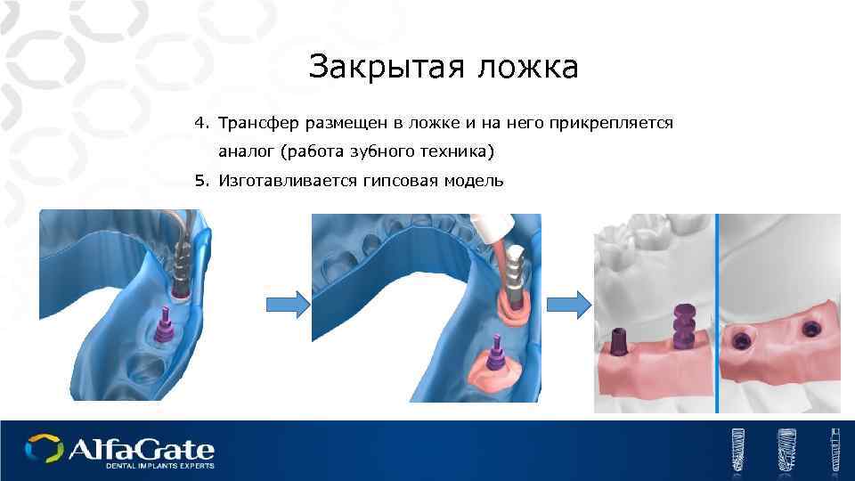 Закрытая ложка 4. Трансфер размещен в ложке и на него прикрепляется аналог (работа зубного