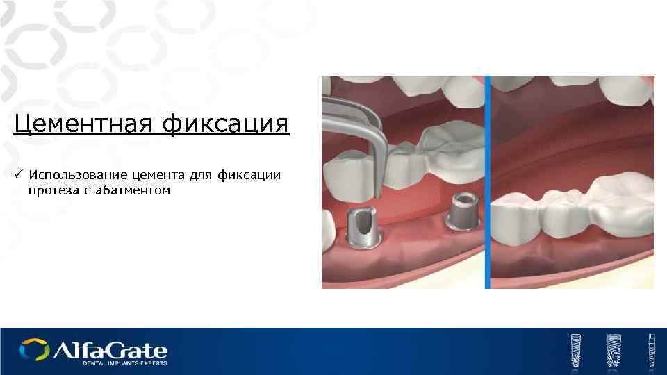 Цементная фиксация ü Использование цемента для фиксации протеза с абатментом 